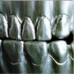 Buy Steel Teeth